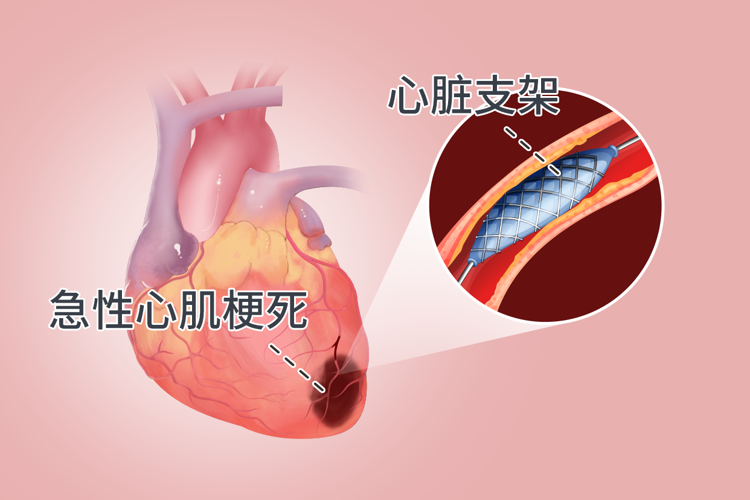 心臟支架手術：到底是治病救人還是“缺德害人”？告訴你真相