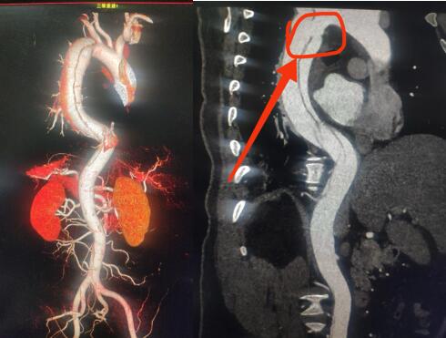 方城縣中醫(yī)院CT室精準(zhǔn)影像診斷救了主動(dòng)脈夾層患者一命