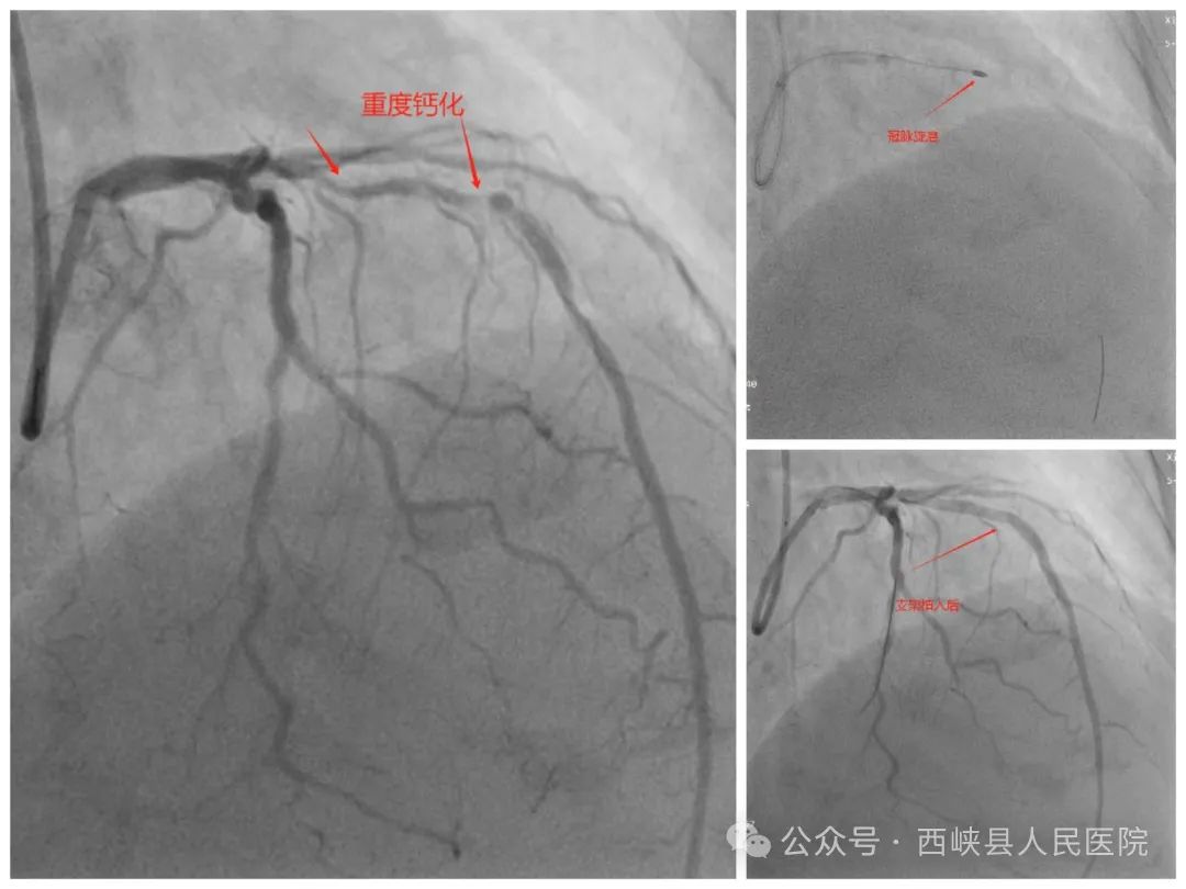 西峽縣人民醫(yī)院成功完成首例冠狀動脈旋磨成形術(shù)